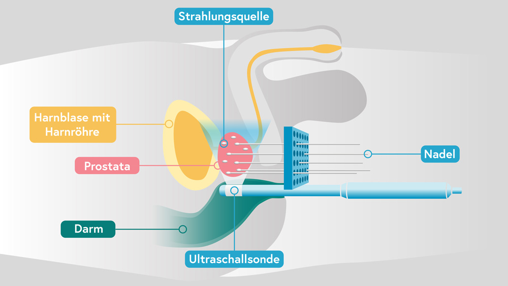 früher Prostatakrebs Brachytherapie