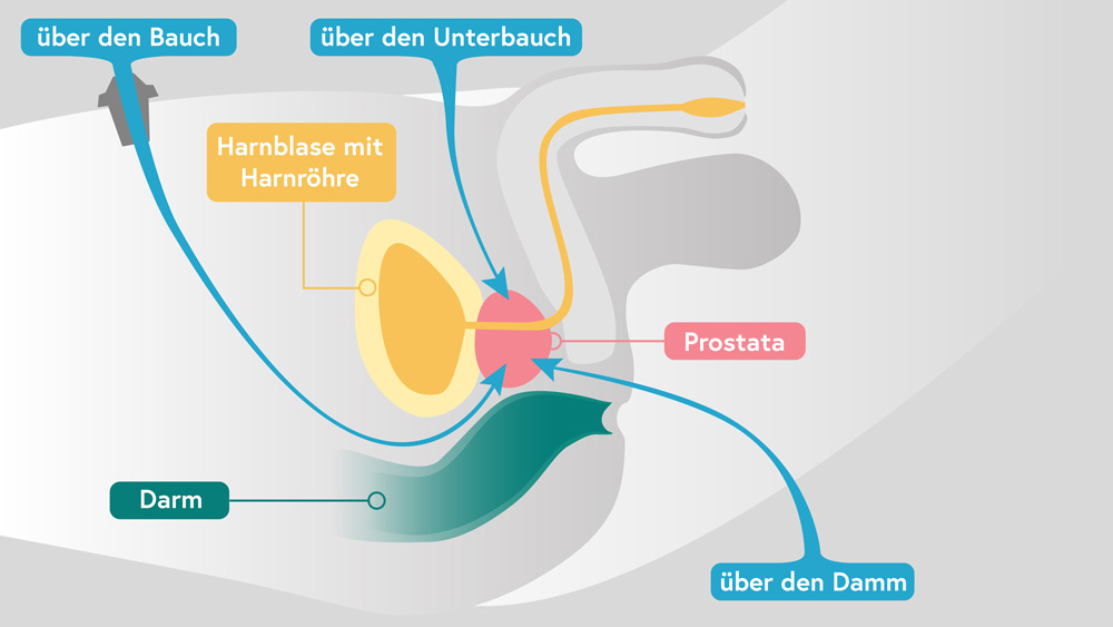 früher Prostatakrebs Zugangswege bei Operation